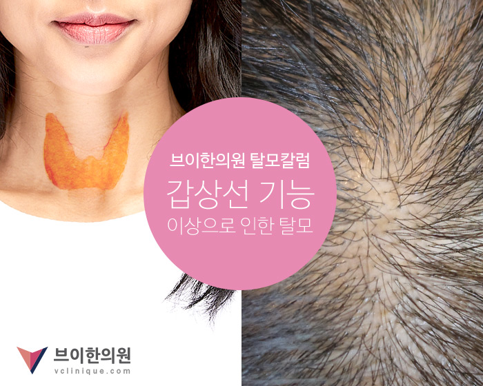 갑상선 기능 이상으로 인한 탈모