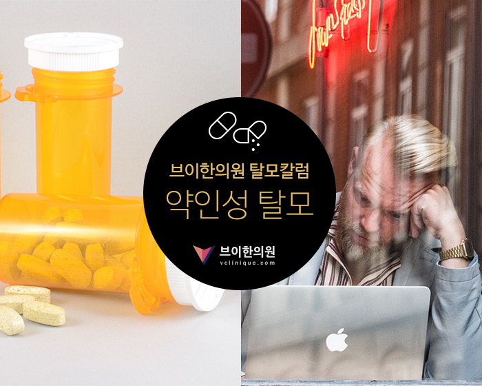 약인성 탈모