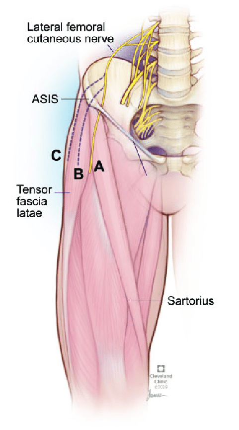 대퇴근막장근(Tensor fascia lata)