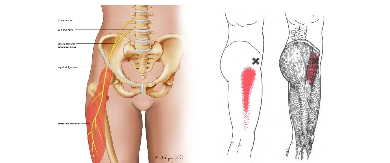 대퇴근막장근(Tensor fascia lata)