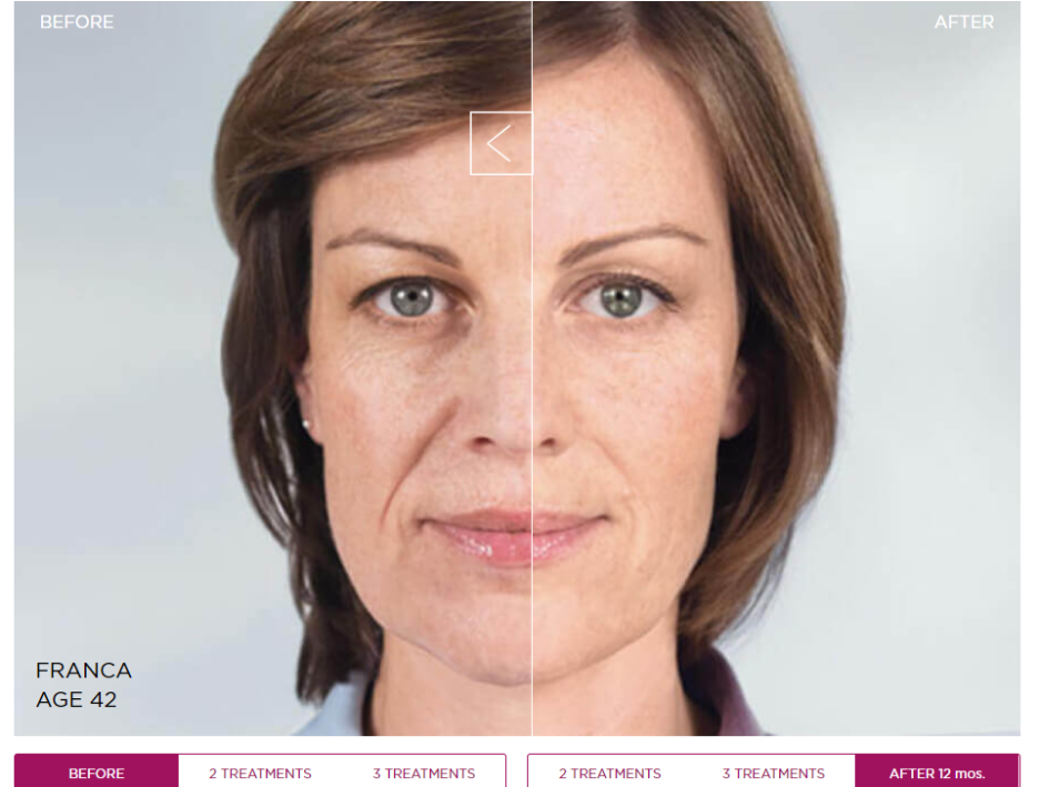 스컬트라 시술 전후