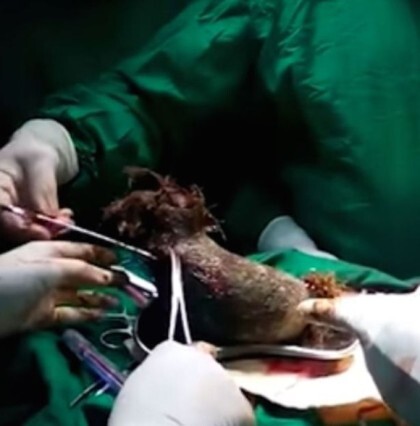 위 속에서 나온 1kg의 머리카락 | 인스티즈