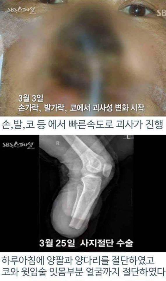 병원의 실수로 하루아침에 사지절단 된 가장 | 인스티즈