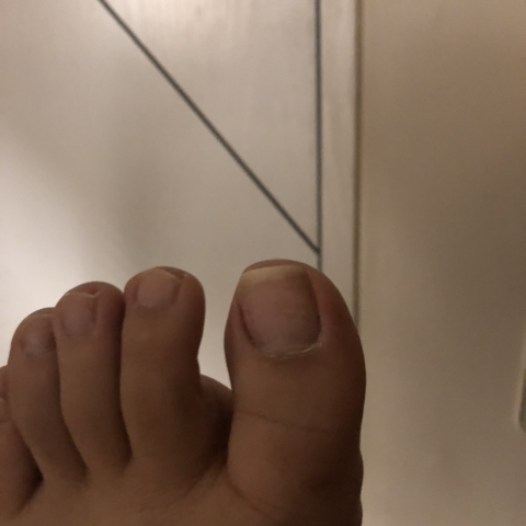 내성발톱수술후기+3년 뒤 현재 근황 (2016년글 재업) | 인스티즈