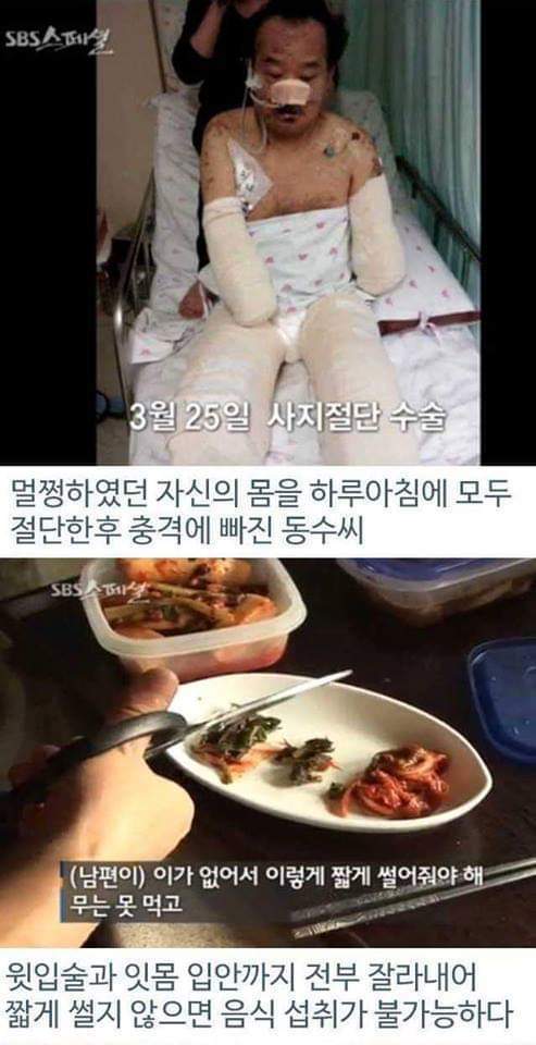 병원의 실수로 하루아침에 사지절단 된 가장 | 인스티즈