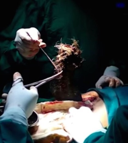 위 속에서 나온 1kg의 머리카락 | 인스티즈