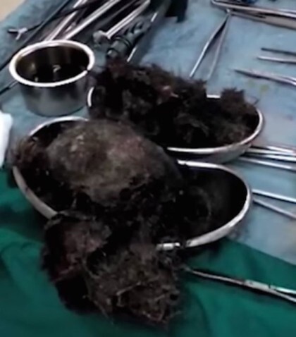 위 속에서 나온 1kg의 머리카락 | 인스티즈