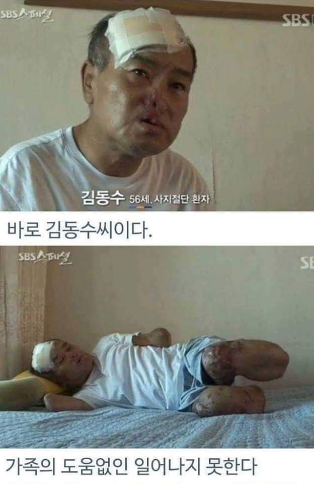 병원의 실수로 하루아침에 사지절단 된 가장 | 인스티즈