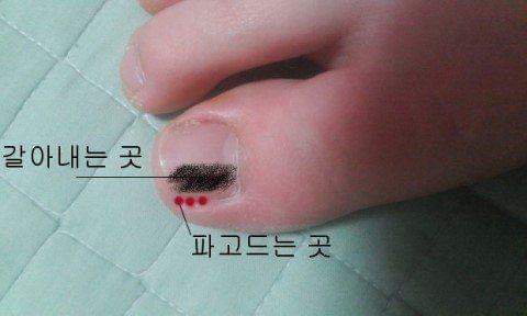 내성발톱 치료 올타임 레전드 갑.jpg | 인스티즈