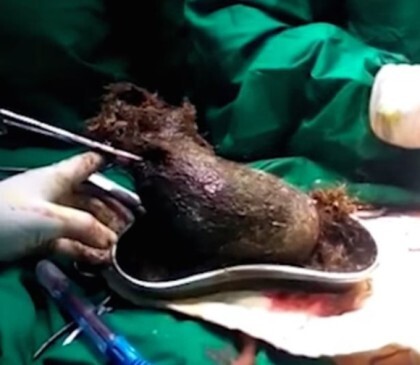 위 속에서 나온 1kg의 머리카락 | 인스티즈