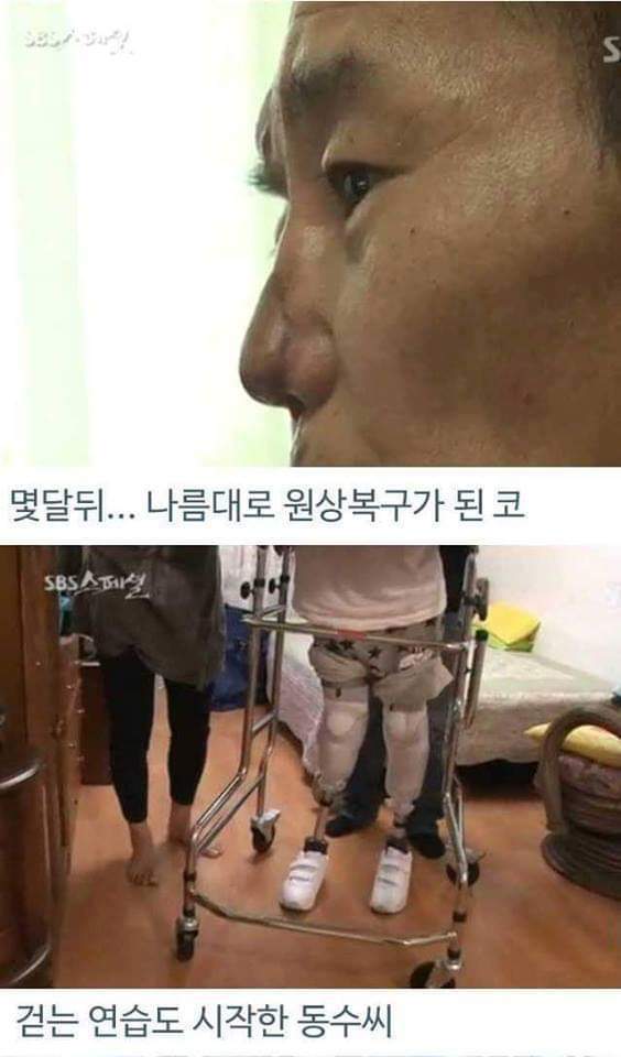 병원의 실수로 하루아침에 사지절단 된 가장 | 인스티즈