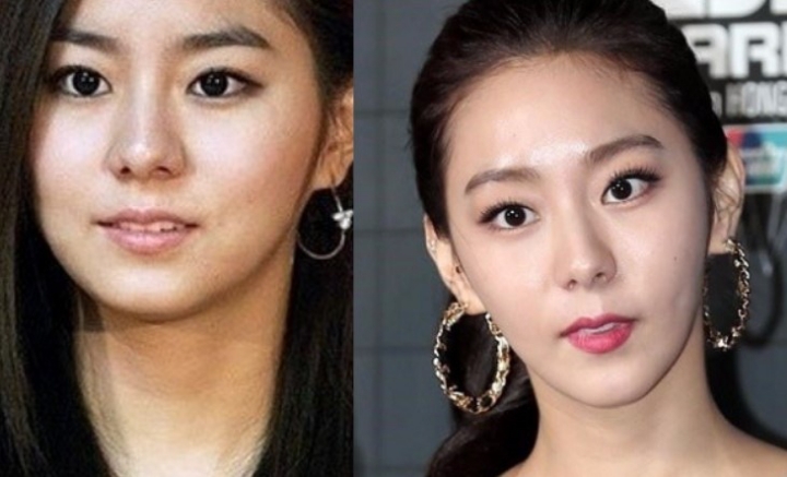 유이 성형 전 후.. | 인스티즈