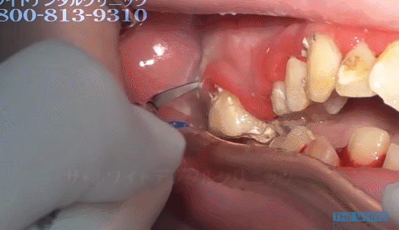 25세 여성의 치석제거. 분명히 난감이라고 말했습니다 (난감주의) | 인스티즈