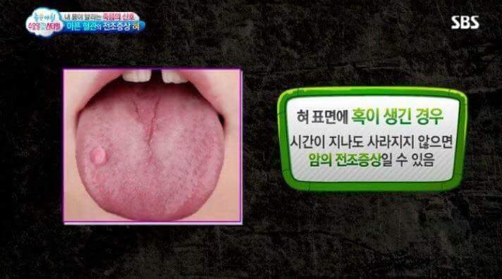 혀의 상태로 알아보는 내 몸의 상태 | 인스티즈