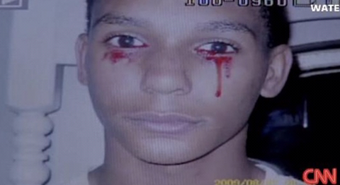 2012년 CNN 헤모라크리아 증상의 소년 | 인스티즈