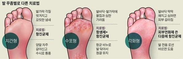 의외로 많은 사람들이 숨기고 있는 질병 | 인스티즈