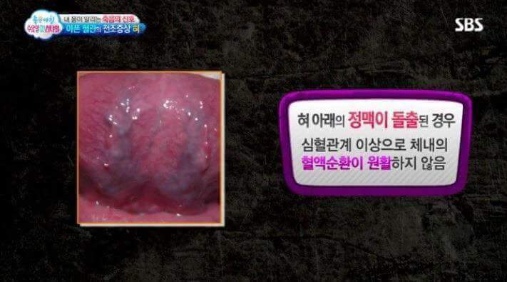 혀의 상태로 알아보는 내 몸의 상태 | 인스티즈