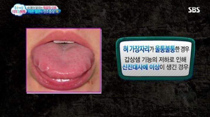 혀의 상태로 알아보는 내 몸의 상태 | 인스티즈
