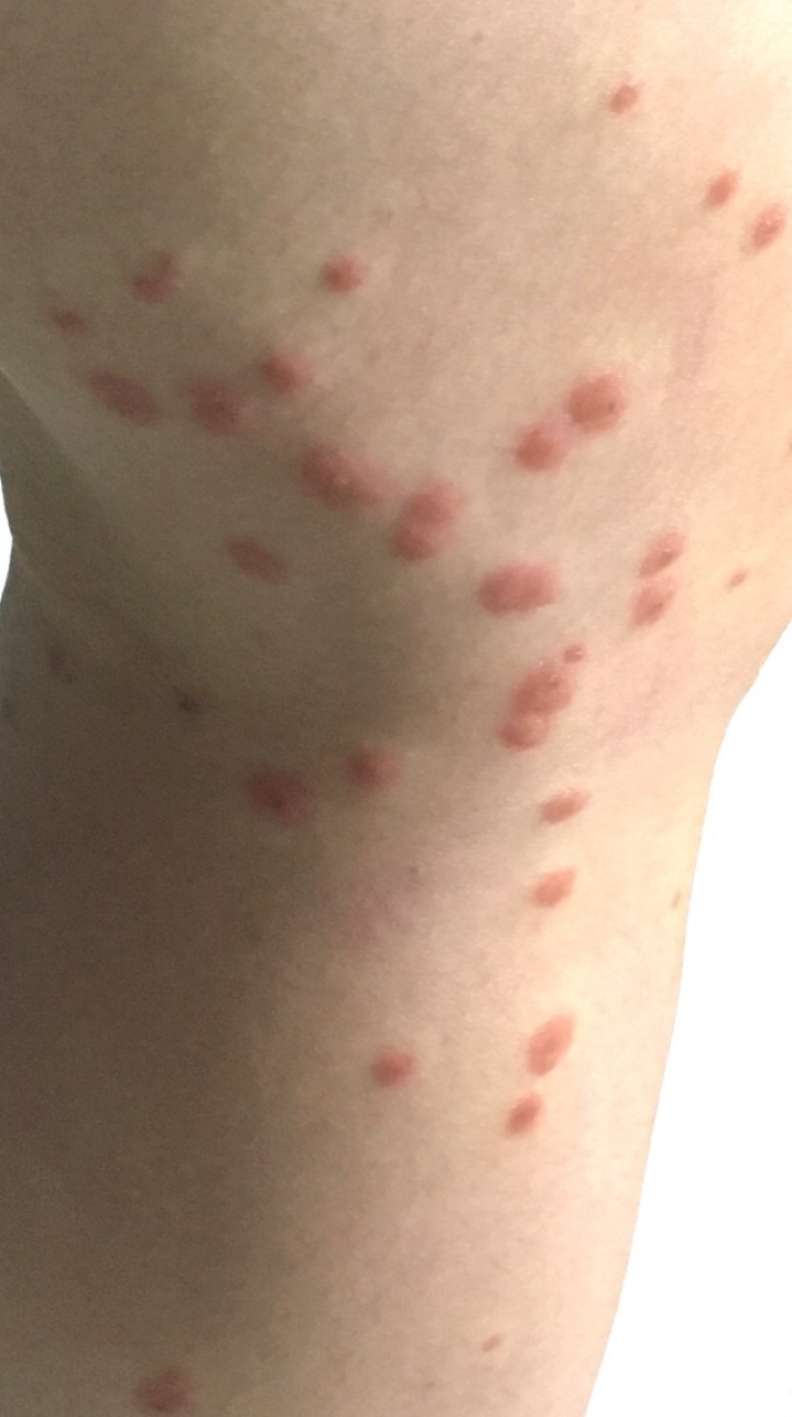 대만 여행에서 주의해야할 대만모기 샌드플라이(샤오헤이원) | 인스티즈