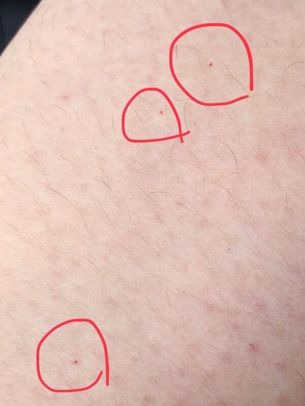 대만 여행에서 주의해야할 대만모기 샌드플라이(샤오헤이원) | 인스티즈