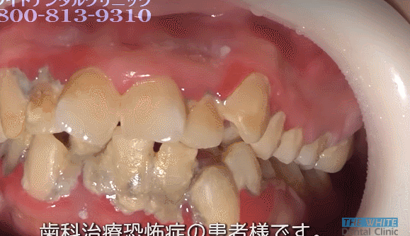 25세 여성의 치석제거. 분명히 난감이라고 말했습니다 (난감주의) | 인스티즈