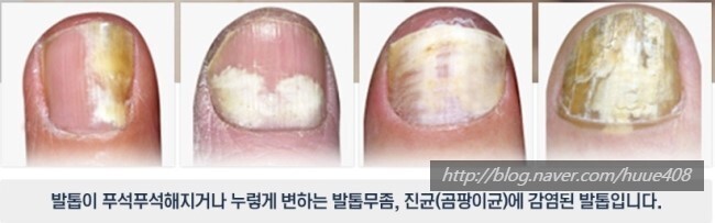 의외로 많은 사람들이 숨기고 있는 질병 | 인스티즈