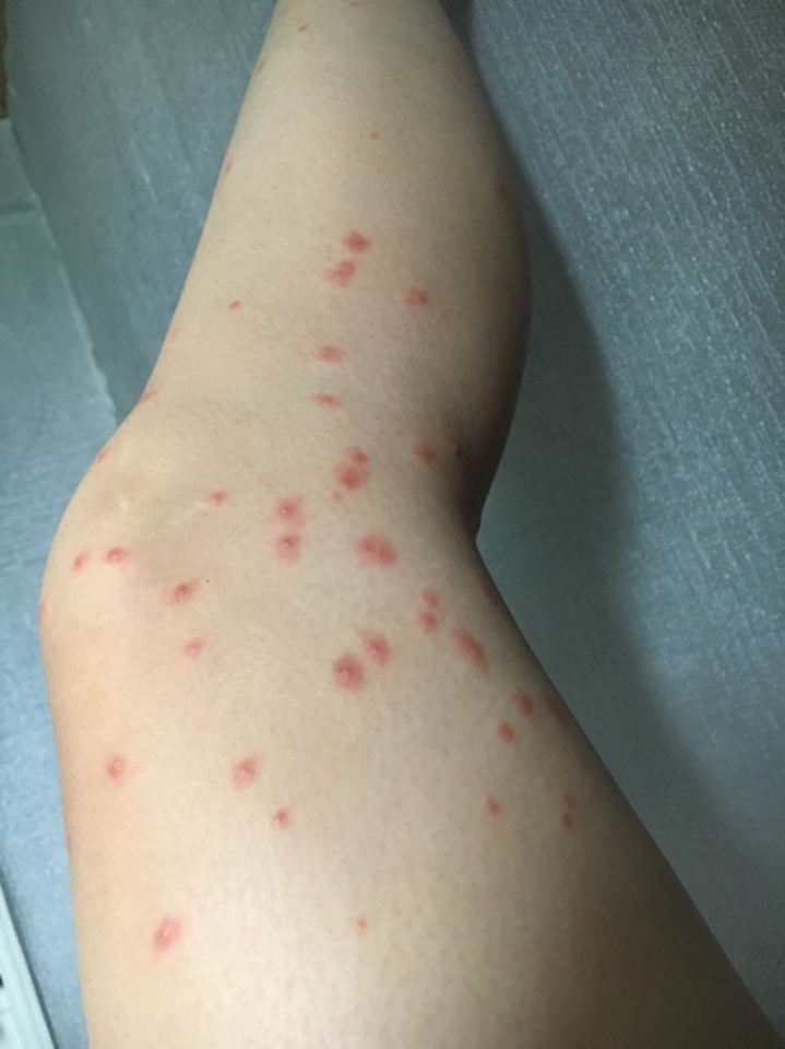 대만 여행에서 주의해야할 대만모기 샌드플라이(샤오헤이원) | 인스티즈