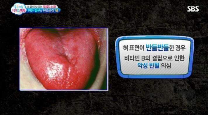 혀의 상태로 알아보는 내 몸의 상태 | 인스티즈