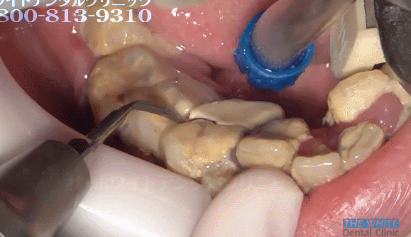 25세 여성의 치석제거. 분명히 난감이라고 말했습니다 (난감주의) | 인스티즈