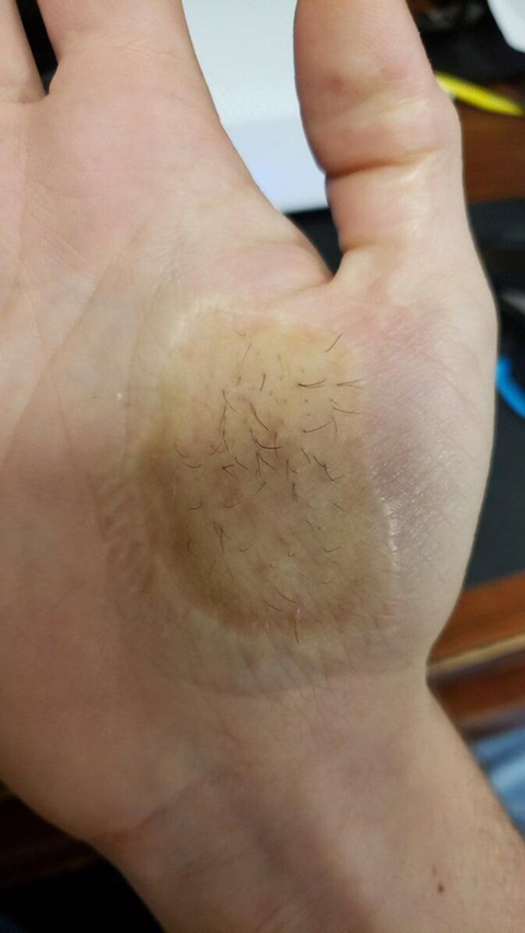 피부이식 대참사 | 인스티즈