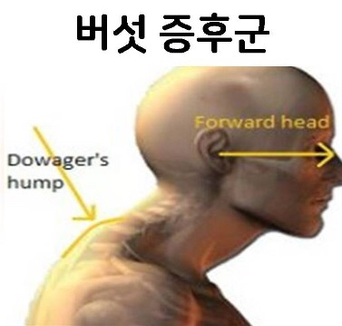 현대인에게 흔히 나타나는 버섯증후군.jpg | 인스티즈