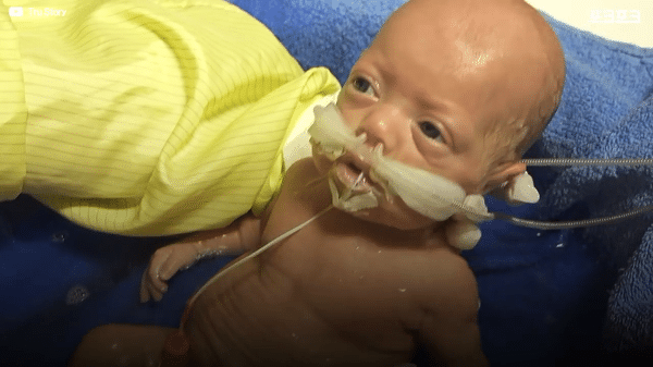 400g으로 태어난 26주 미숙아의 기적의 여정...JPG | 인스티즈