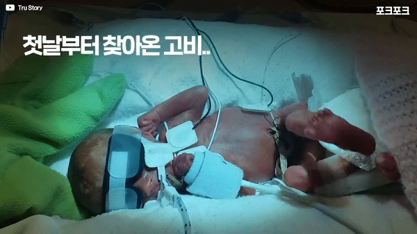 400g으로 태어난 26주 미숙아의 기적의 여정...JPG | 인스티즈