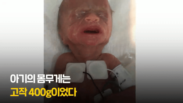 400g으로 태어난 26주 미숙아의 기적의 여정...JPG | 인스티즈