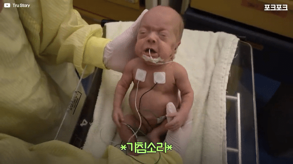 400g으로 태어난 26주 미숙아의 기적의 여정...JPG | 인스티즈