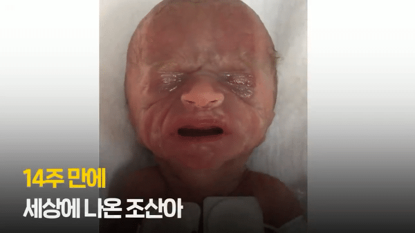 400g으로 태어난 26주 미숙아의 기적의 여정...JPG | 인스티즈