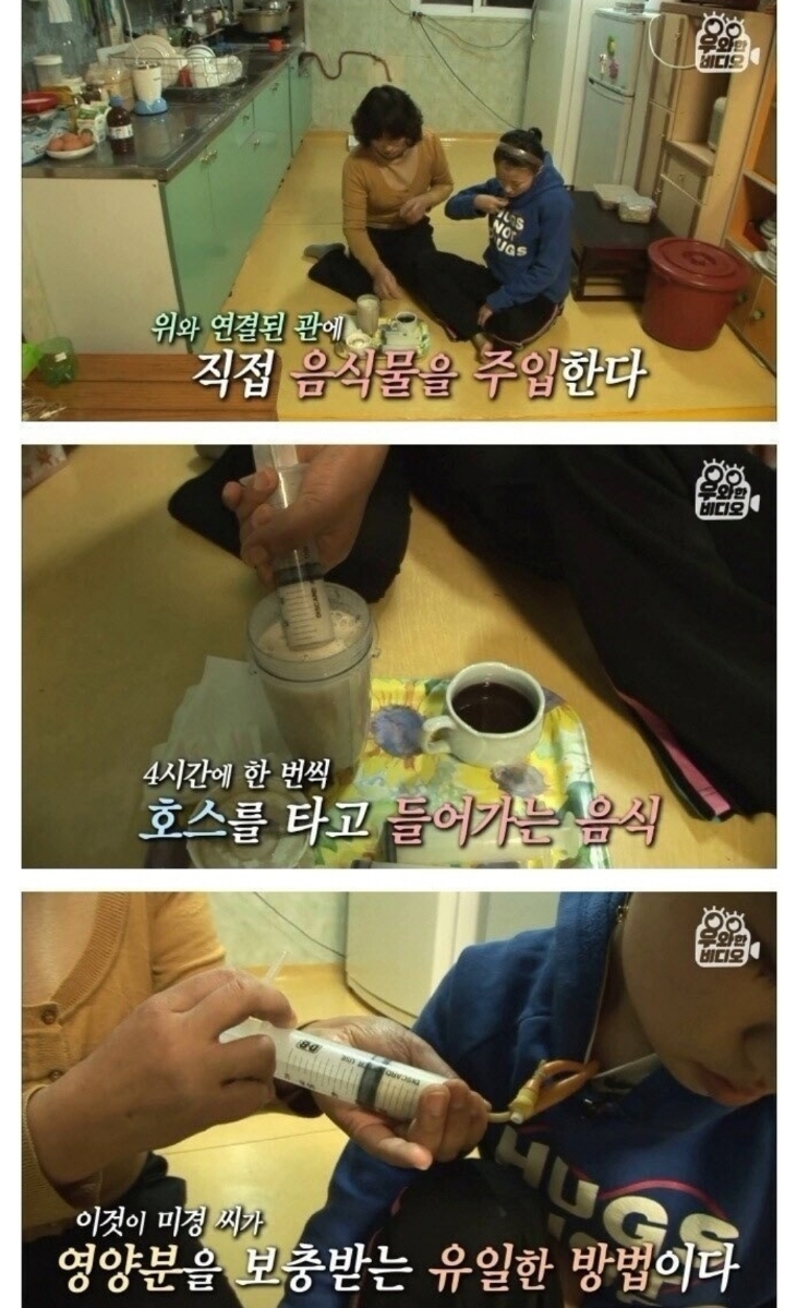 스압) 식도가 없이 태어난 아이.jpg | 인스티즈