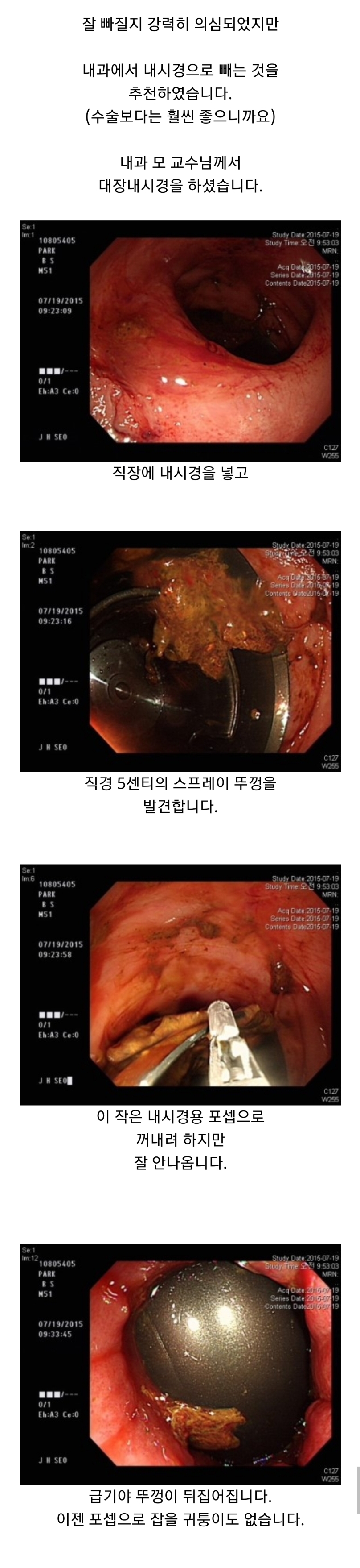 항문에 뭐좀 넣지마세요 (혐오주의) | 인스티즈