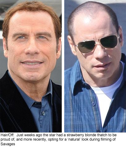 모발이식 성공사례 | 인스티즈