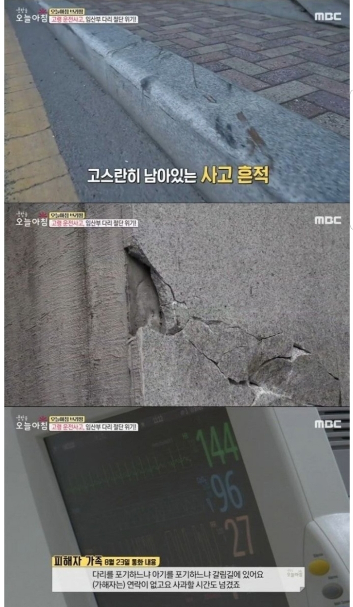 아기를 위해 마취 없이 8시간 수술을 받은 임산부.jpg | 인스티즈