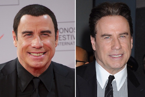 모발이식 성공사례 | 인스티즈