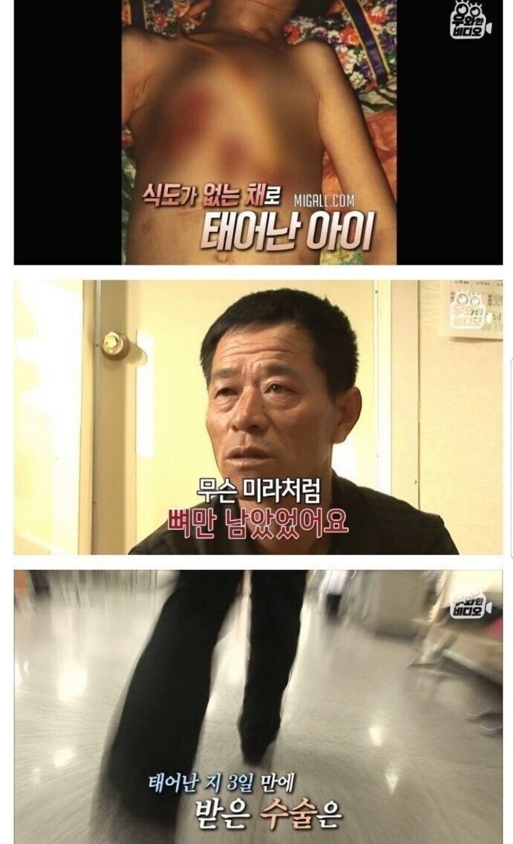 스압) 식도가 없이 태어난 아이.jpg | 인스티즈