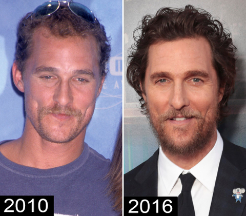 모발이식 성공사례 | 인스티즈