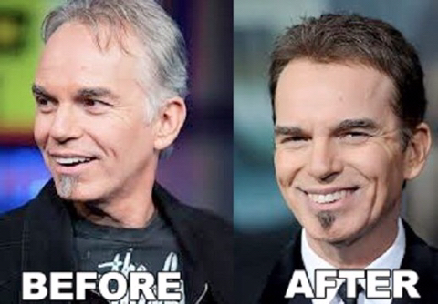 모발이식 성공사례 | 인스티즈