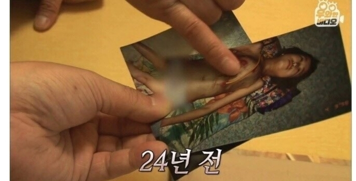 스압) 식도가 없이 태어난 아이.jpg | 인스티즈