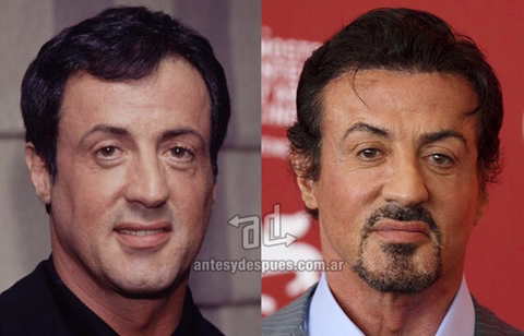 모발이식 성공사례 | 인스티즈