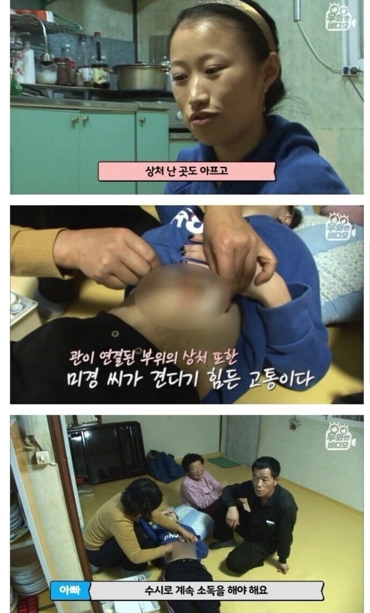 스압) 식도가 없이 태어난 아이.jpg | 인스티즈