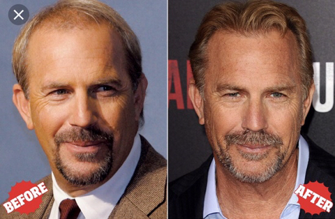 모발이식 성공사례 | 인스티즈