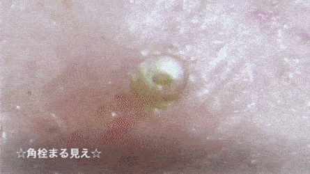 최고 속쉬원한 왕피지 제거짤 보실분(혐오주의) | 인스티즈