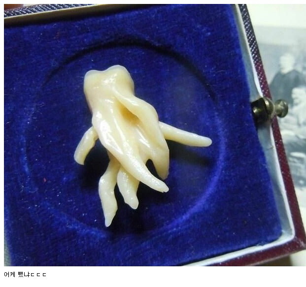 사랑니 레전드.jpg | 인스티즈